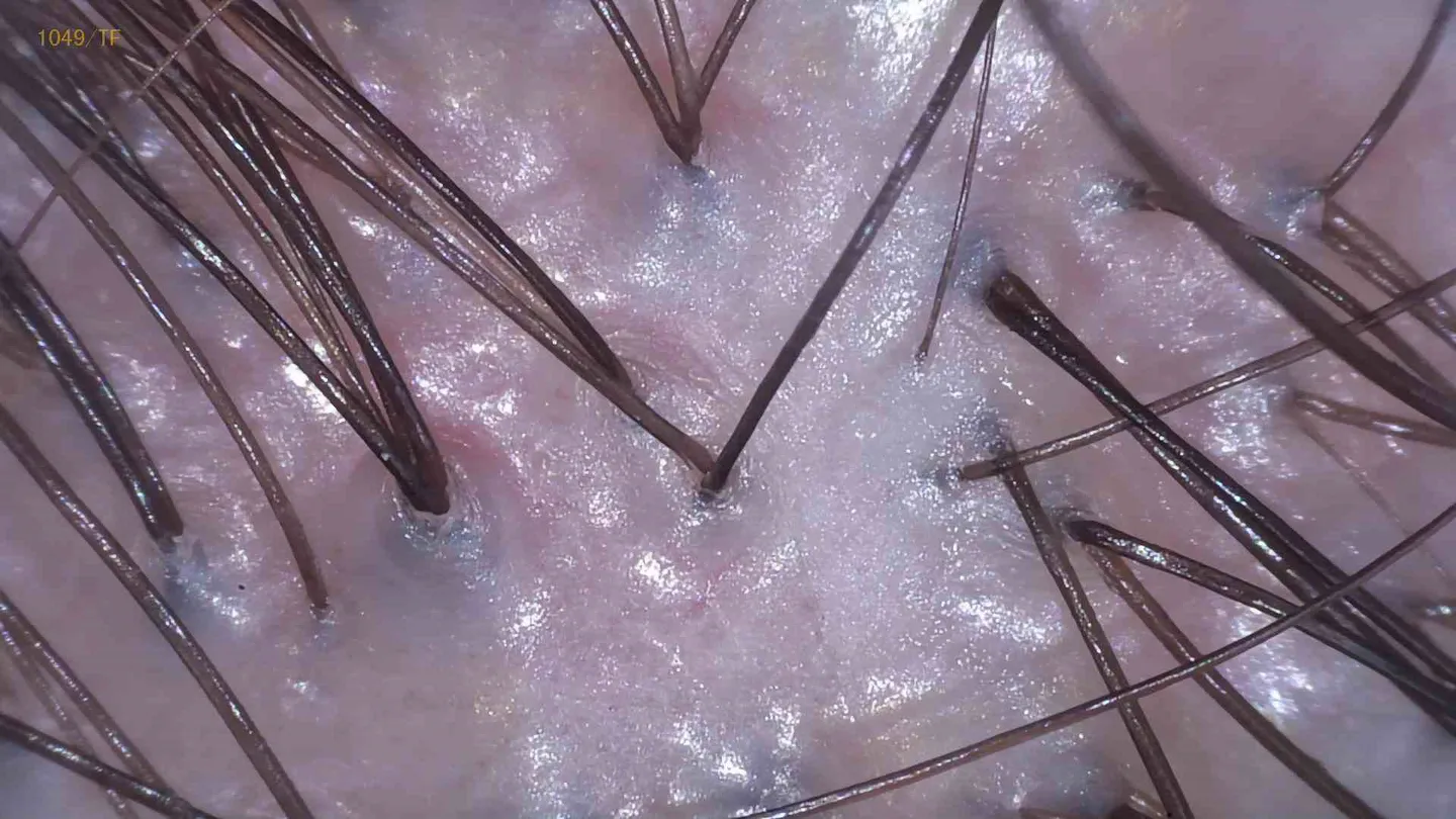 Łuszczyca — obraz mikroskopowy skóry głowy po zabiegu oczyszczania, widoczna poprawa