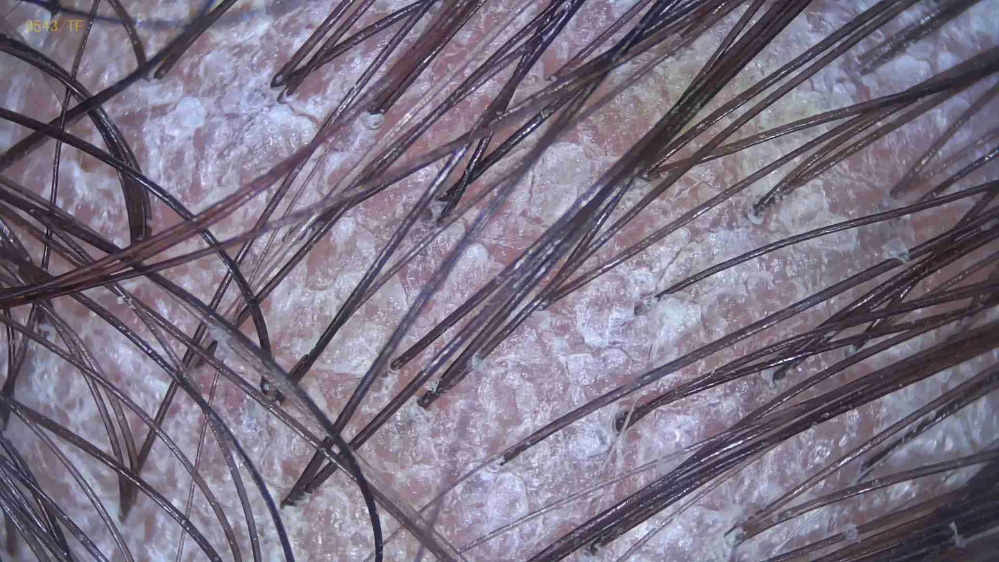 Łuszczyca — obraz mikroskopowy skóry głowy przed zabiegiem oczyszczania