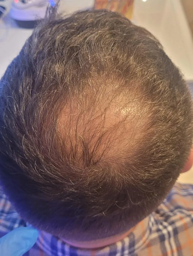 Łysienie androgenowe — 3 miesiące po rozpoczęciu terapii, widoczna poprawa