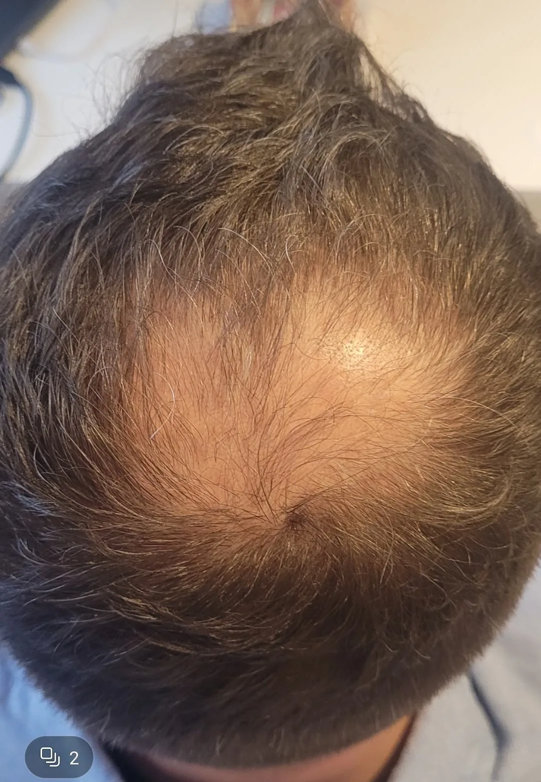 Łysienie androgenowe — przed rozpoczęciem terapii