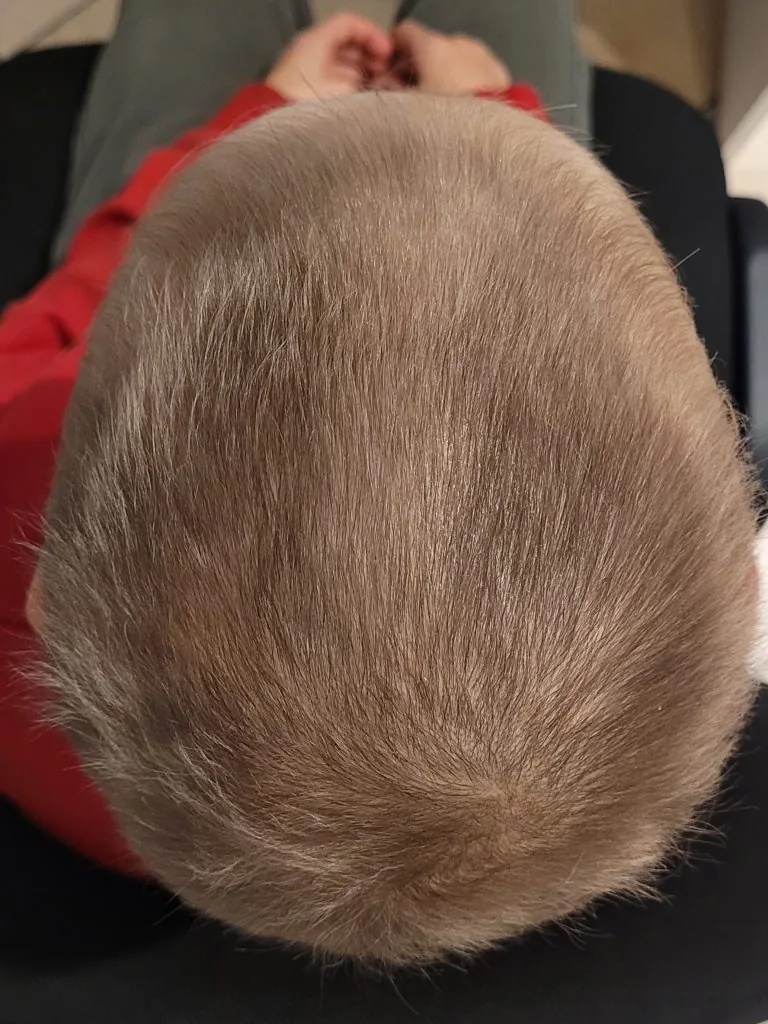 Łysienie plackowate — po 2 miesiącach terapii, widoczny odrost włosów