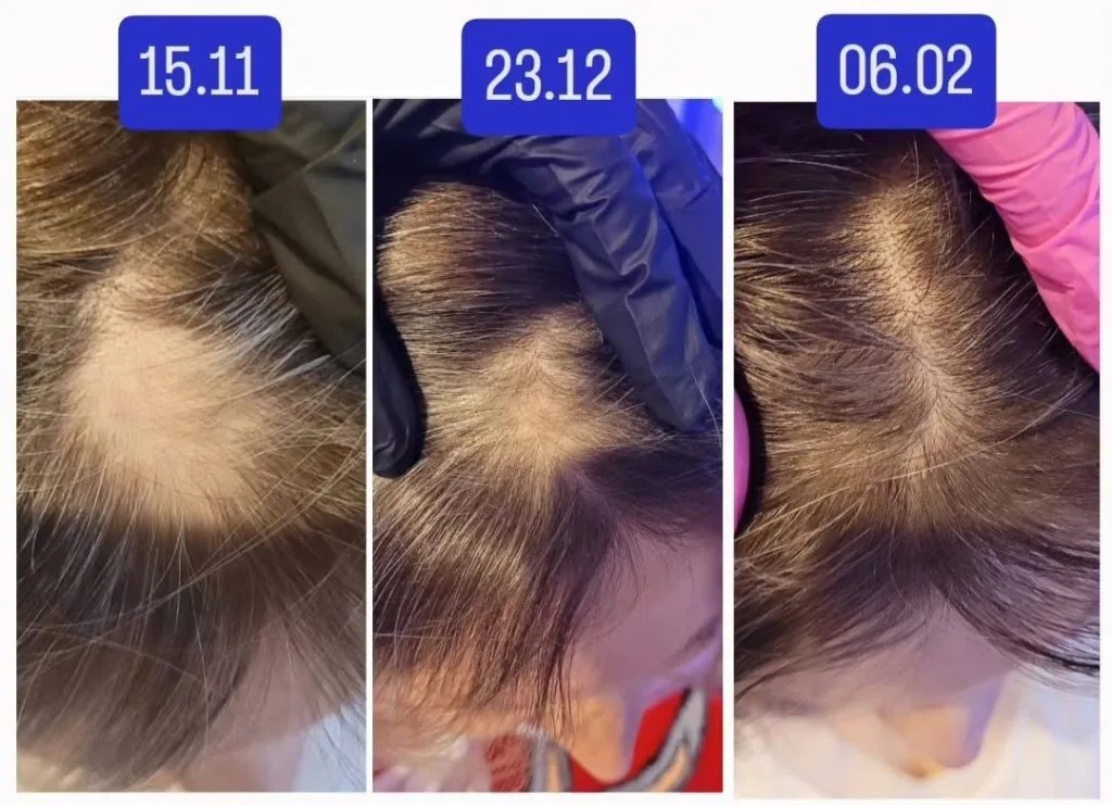 Łysienie plackowate — efekty terapii, 3 fazy: 15.11.2024, 23.12.2024, 06.02.2025