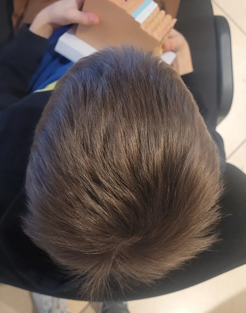 Łysienie plackowate — po 4 miesiącach terapii, znaczny odrost, ognisko niemal zanikło