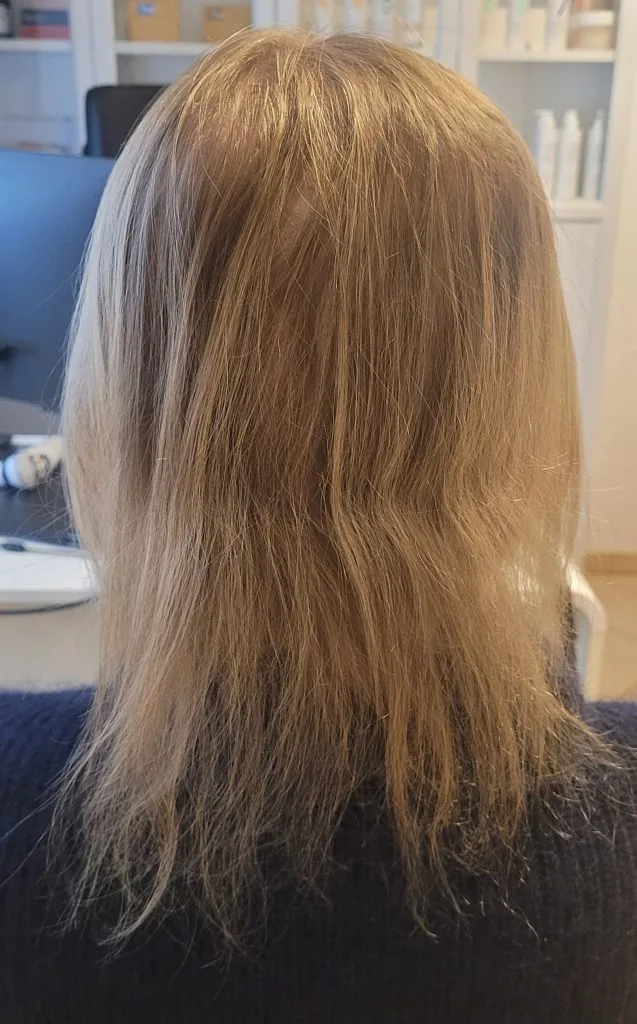 Łysienie telogenowe — po terapii, widoczna poprawa, 25.02.2025