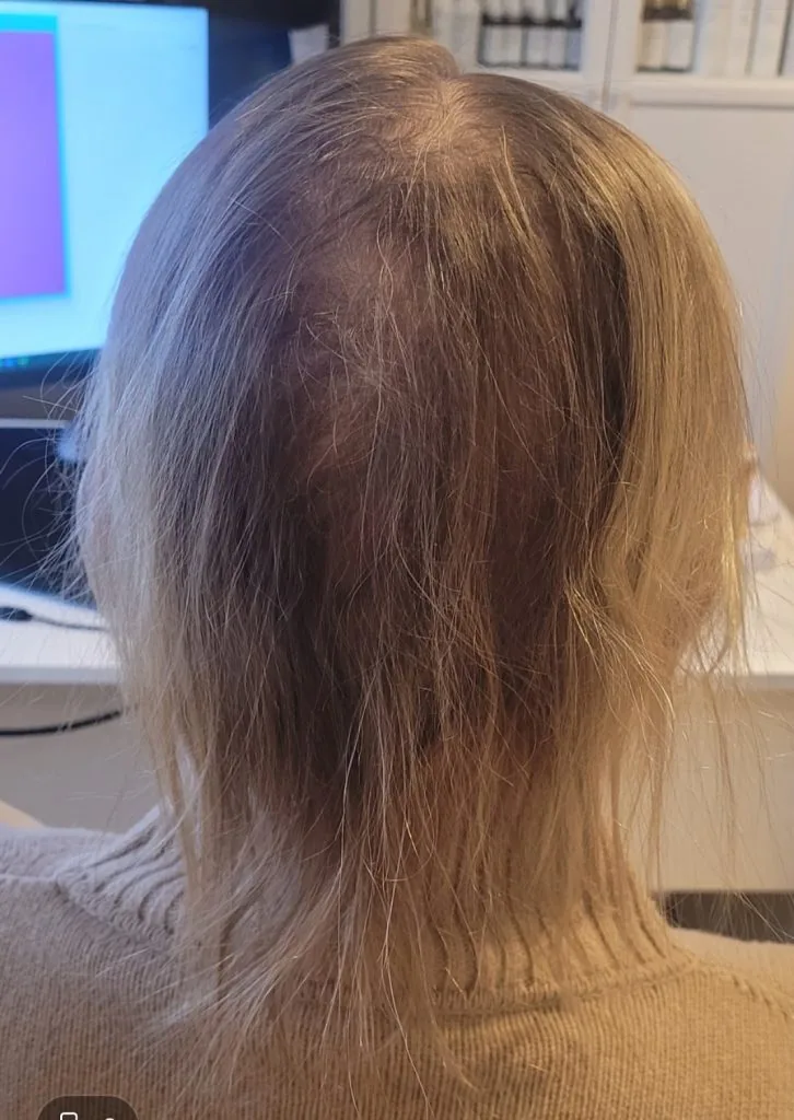 Łysienie telogenowe — przed rozpoczęciem terapii, 20.01.2025