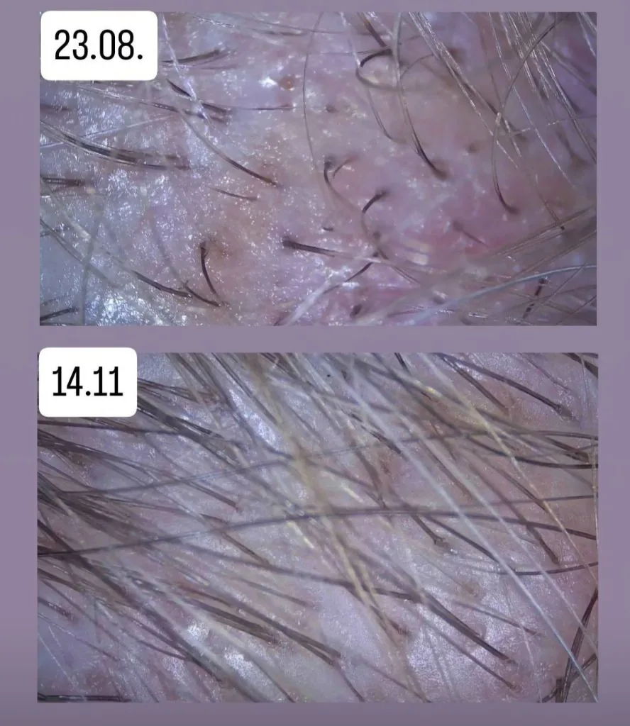 Łysienie telogenowe — efekty terapii, porównanie sierpień vs listopad