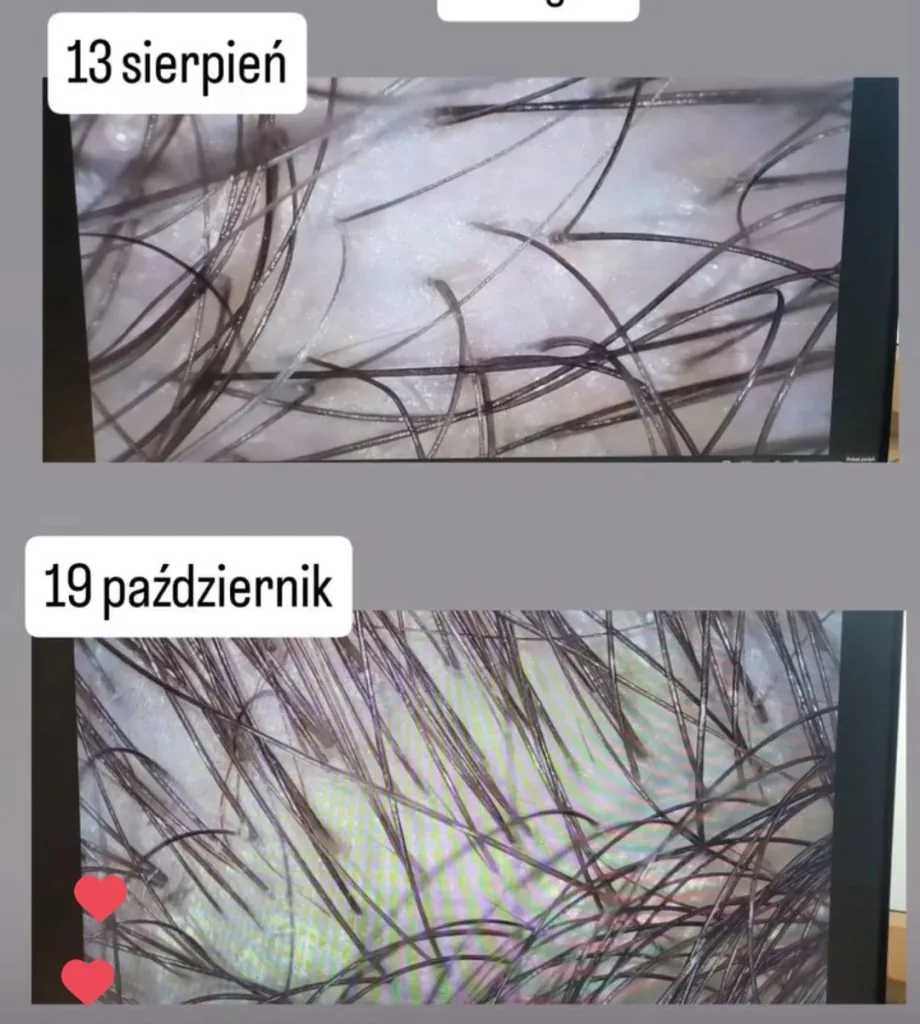 Łysienie telogenowe — efekty terapii, porównanie sierpień vs październik