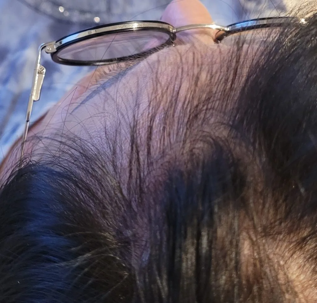 Łysienie telogenowe — efekty terapii, widok na skronie