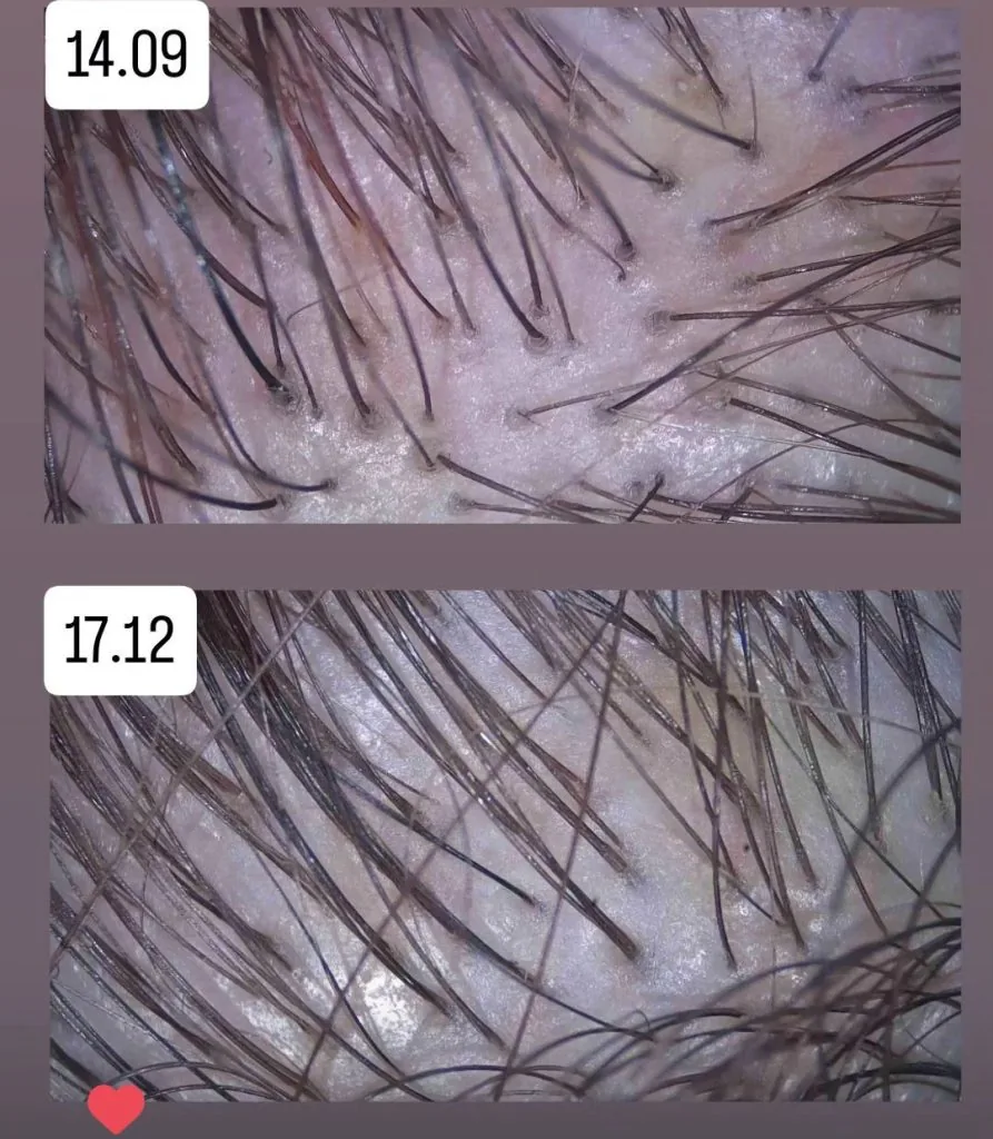 Łysienie telogenowe — efekty terapii, porównanie wrzesień vs grudzień